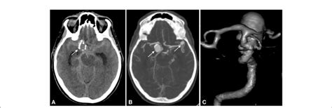 Figure Ncct Subarachnoid Hemorrhage In The Basal And Sylvian Cistern