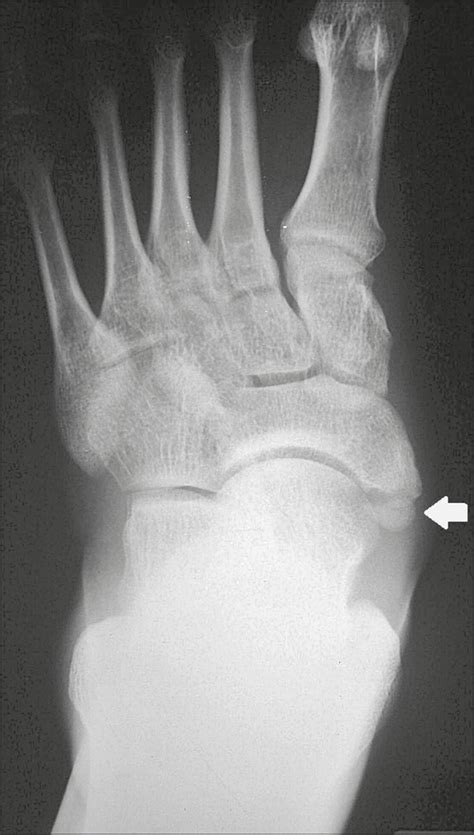 small  troublesome accessory ossicles  clinical significance pmc