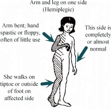 Week 3 Upper Vs Lower Motor Neuron Lesions Flashcards Quizlet