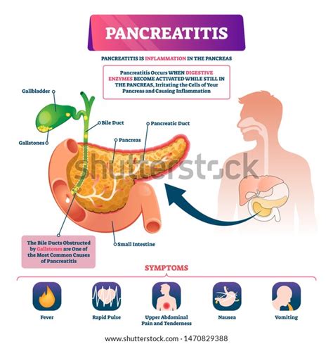 Pancreatitis Vector Illustration Labeled Sick Pancreas 库存矢量图（免版税）1470829388