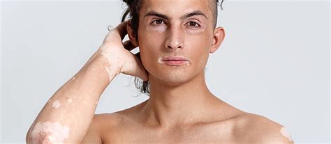 Vitiligo: causes and symptoms – Dr. Matteo Bordignon