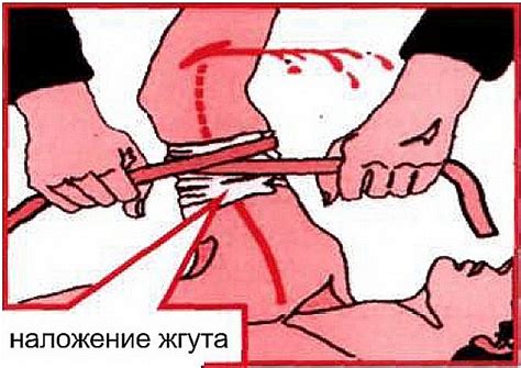 Остановка кровотечения