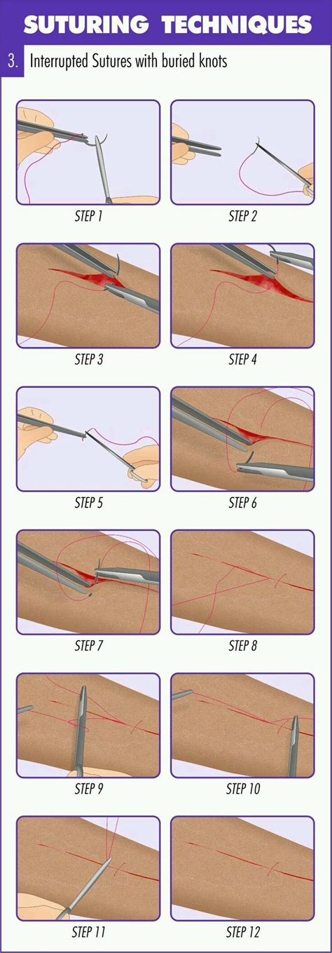 11 best Suture methods images on Pinterest | Anatomy, Survival skills ...