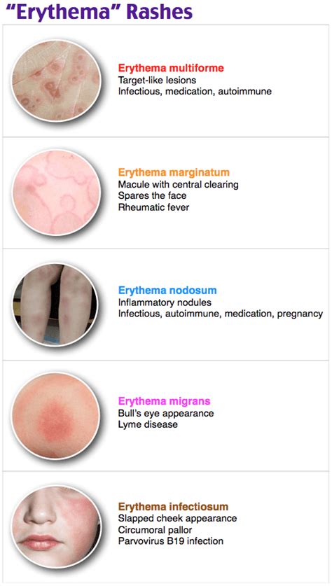 Erythema Migrans Vs Erythema Multiforme