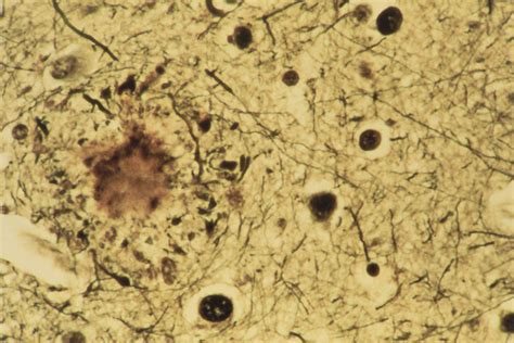 New Biologic Is Active Against Alzheimers Amyloid Plaques The