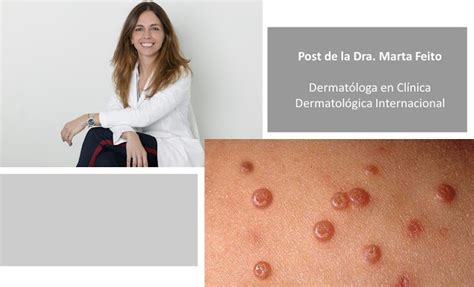 Vuelta Al Cole ¡cuidado Con Los Moluscum