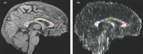 Sex Differences In The Human Corpus Callosum Diffusion Tens NeuroReport
