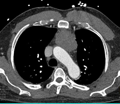 thymoma chest radiology case studies ctisus ct scanning