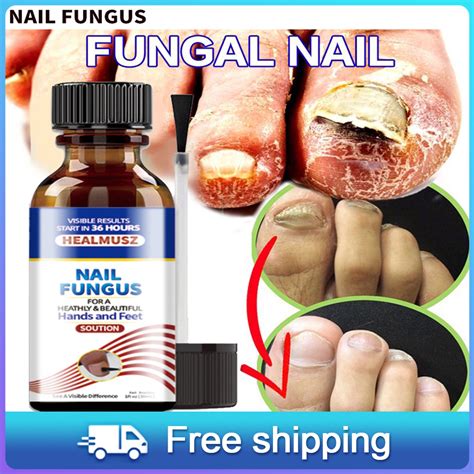 Healmusz Nail Fungus Treatment Essence Removes Onychomycosis Nails
