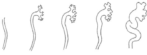 International Classification Of Vesicoureteral Reflux International Download Scientific