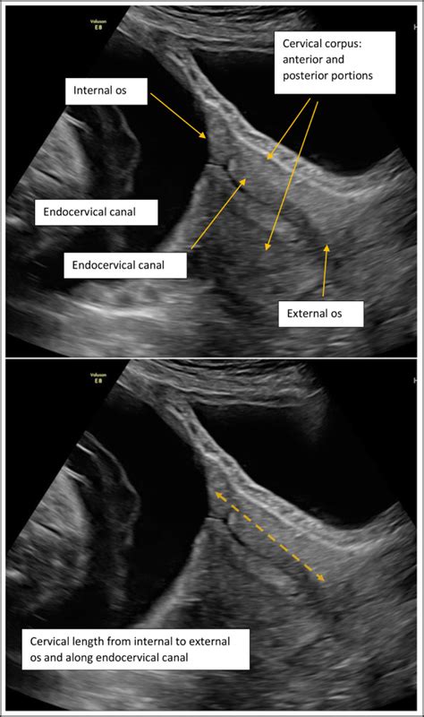 Guideline No 401 Sonographic Cervical Length In Singleton Pregnancies