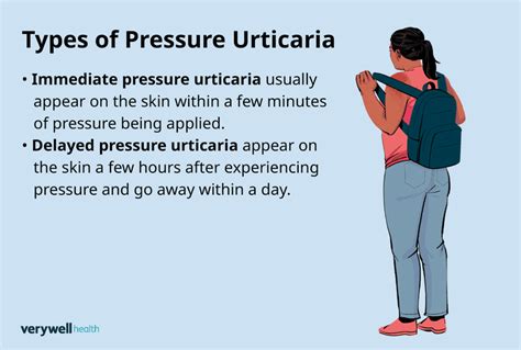 Pressure Urticaria Symptoms Causes And Treatment