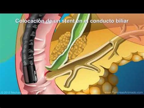 Colocación de stent BILIAR y pancreatico YouTube