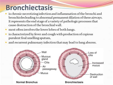 Saccular Bronchiectasis Understanding Causes Symptoms And Treatment Options