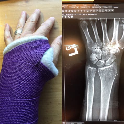 My wrist broke my fall; my fall broke my wrist. – Imitating Life
