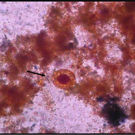 Lugol S Iodine Stained Stools Smear Showing Blastocystis Hominis Cyst