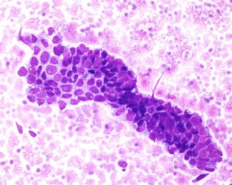 Embryonal carcinoma - Eurocytology