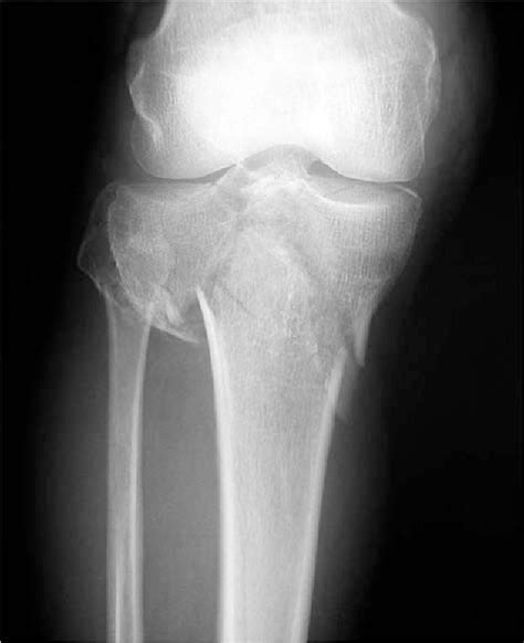 Figure From Treatment Of Complex Tibial Plateau Fractures Using