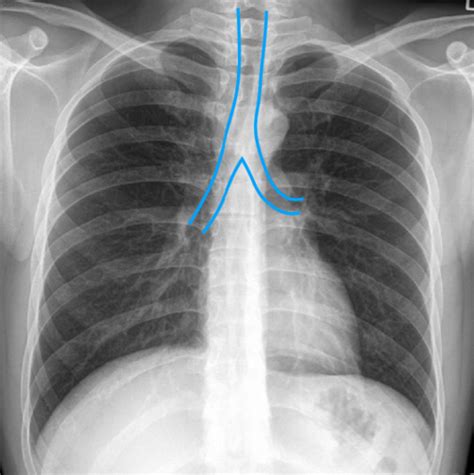 110 07 Introductory Radiology On Neck And Thorax Thorax Imaging