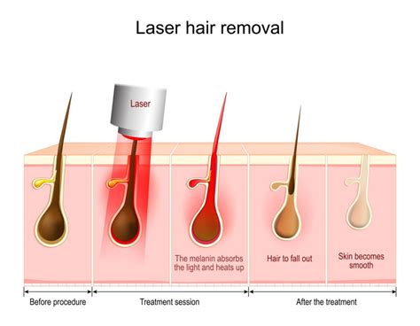 Laser Hair Removal Work On Blonde Hair at Jean Begaye blog