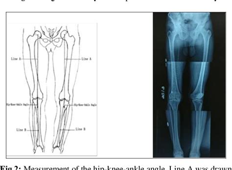 Figure From A Case Series Of Functional Outcome Of Proximal Fibular