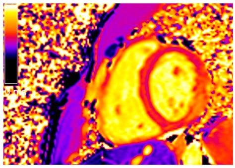 Short Axis Native T1 Mapping Image Of The Same Patient Shown In Figure