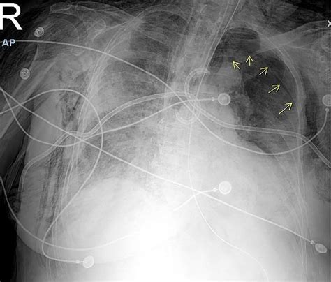 Hospital Day 11 Worsening Left Sided Pneumothorax With Bilateral