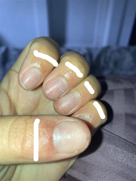 I have these bumps and a rash from doing my nails please help !! : r