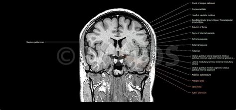 Brain Coronal Sectionbasal Nuclei And Related Structures Corpus