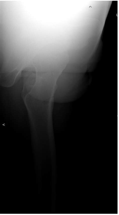 Conservative Treatment Of A Nondisplaced Intertrochanteric Femur