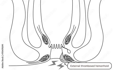 Diseases Of The Anus Hemorrhoids And Warts Thrombosed External