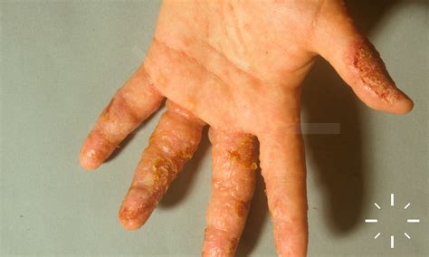 Severe Dyshidrosis