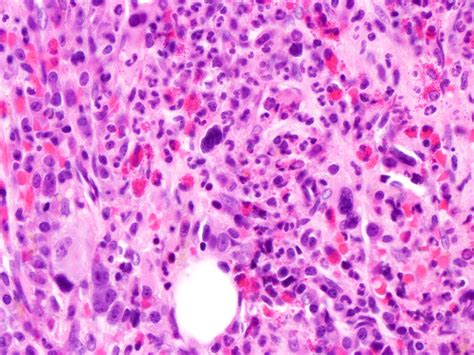 Pathology Outlines - MDS / MPN with SF3B1 and thrombocytosis