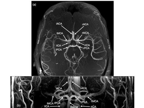 Circle Of Willis Mri Labeled