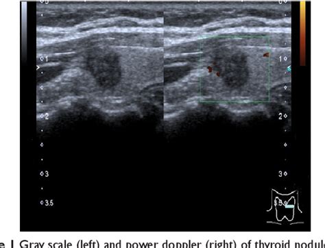 Figure 1 From A Case Of Papillary Thyroid Carcinoma Discovered By