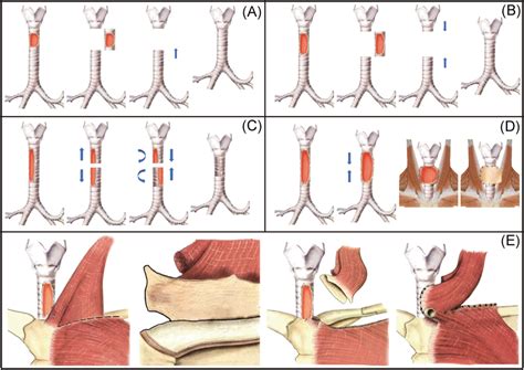 Reconstruction Strategies For Each Classification Of Tracheal Defects