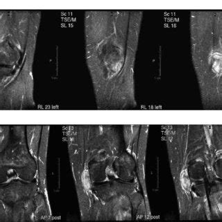 A Sinovitis Vellonodular Pigmentada Tipo Focal En La Rodilla En La