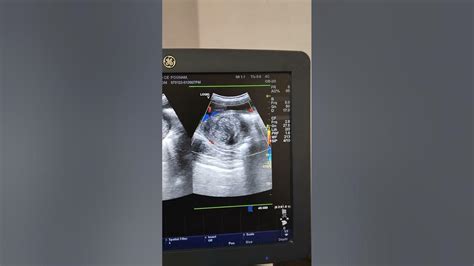 subserosal fibroid  fetus ultrasound youtube