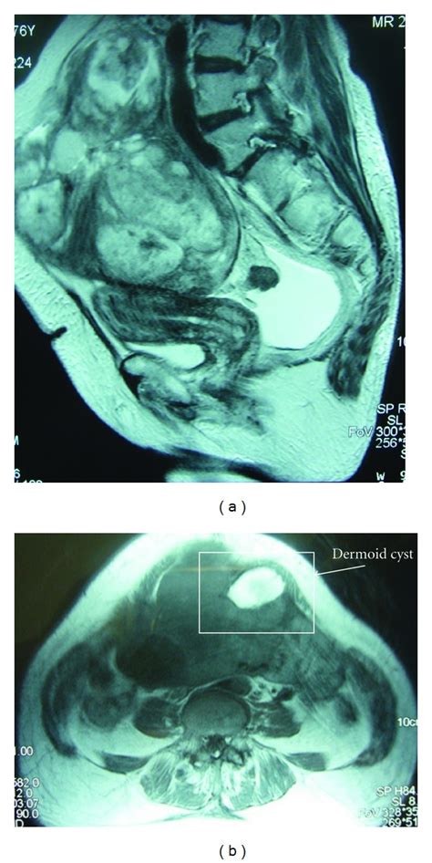 A Sagittal T2 Weighted Mr Image Shows A Large Solid And Cystic