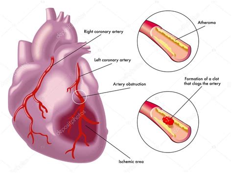 Esquema De Infarto De Miocardio Stock Vector By Rob