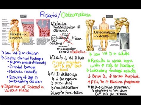 Rickets In Adults