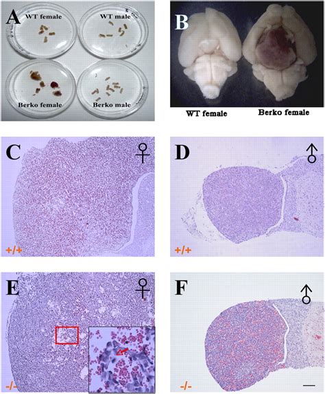 Gonadotropin Positive Pituitary Tumors Accompanied By Ovarian Tumors In