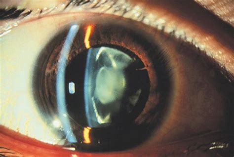 Some Essential Facts About Cataract Every One Must Know Before Going