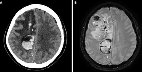 COVID 19 Associated Cerebral Developmental Venous Anomaly Thrombosis