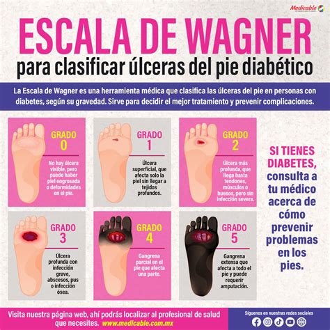 Escala de Wagner para clasificar úlceras el pie diabético. | Medicable