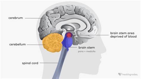 Brain Stem Stroke Symptoms Causes Treatments Recovery