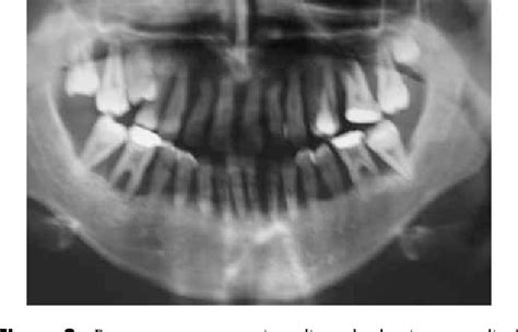 Figure 2 From Oral Rehabilitation Of A Case Of Papillon Lefevre