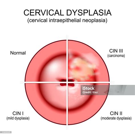 Cervical Dysplasia Closeup Of A Cervix Cervical Cancer Stock