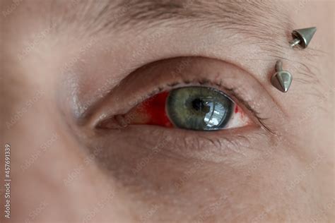 Close Up Of A Male Human Eye With Broken Blood Vessels Subconjunctival