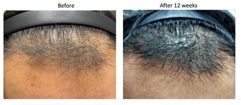 Laser Hair Loss Treatment Englewood NJ Better U Medical Spa